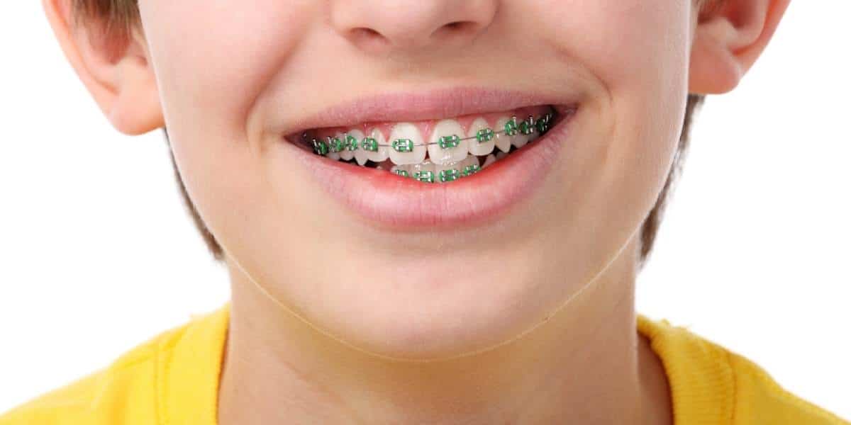 New Braces 101: Tips From the Mom of a Kid with Braces - Lakeland Mom